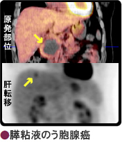 膵粘液のう胞腺癌