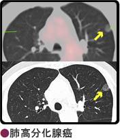 肺高分化腺癌