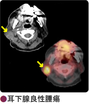 耳下腺良性腫瘍