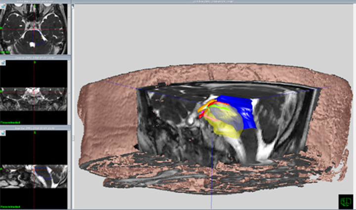 頭蓋底髄膜腫術前シミュレーション３D画像